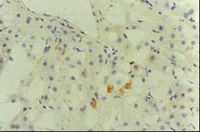 Immunohistochemical detection of HCV core protein.