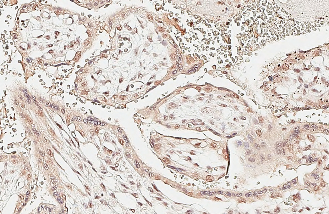 Rad21 antibody [HL3416] detects Rad21 protein by immunohistochemical analysis. Sample: Paraffin-embedded human placenta. Rad21 stained by Rad21 antibody [HL3416] (GTX641258) diluted at 1:200. Antigen Retrieval: Citrate buffer, pH 6.0, 15 min