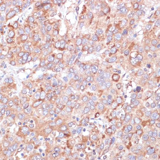 IHC-P analysis of human liver cancer tissue using GTX64336 YAP1 antibody. Dilution : 1:100