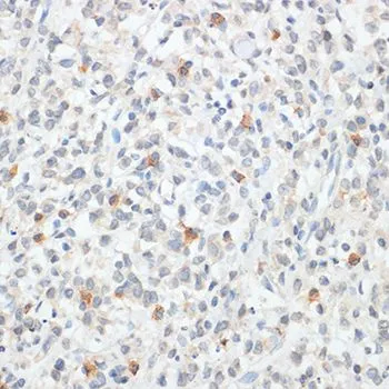 IHC-P analysis of human gastric cancer tissue using GTX64343 FOXP3 antibody. Dilution : 1:100