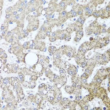 IHC-P analysis of human liver damage tissue using GTX64349 TSG101 antibody. Dilution : 1:100