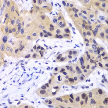 IHC-P analysis of human esophageal cancer tissue using GTX64358 IRF3 antibody. Dilution : 1:100