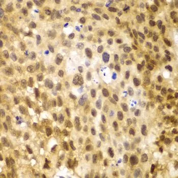 IHC-P analysis of human lung cancer tissue using GTX64358 IRF3 antibody. Dilution : 1:100