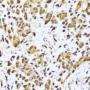 IHC-P analysis of human gastric cancer tissue using GTX64359 Ku70 antibody. Dilution : 1:100