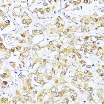 IHC-P analysis of human liver cancer tissue using GTX64363 eIF2 alpha antibody. Dilution : 1:100
