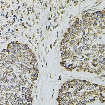 IHC-P analysis of human esophageal cancer tissue using GTX64365 CD62P antibody. Dilution : 1:100