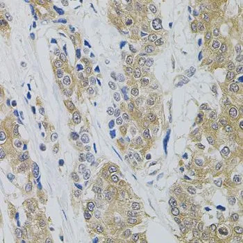 IHC-P analysis of human prostate cancer tissue using GTX64478 Dynamin 2 antibody.