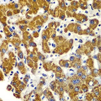 IHC-P analysis of human liver damage tissue using GTX64515 SMAD9 antibody. Dilution : 1:100