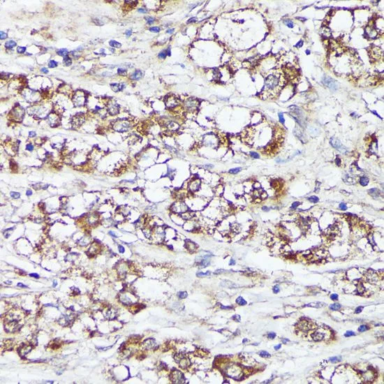 IHC-P analysis of human liver cancer tissue using GTX64519 MTHFD2 antibody. Dilution : 1:100