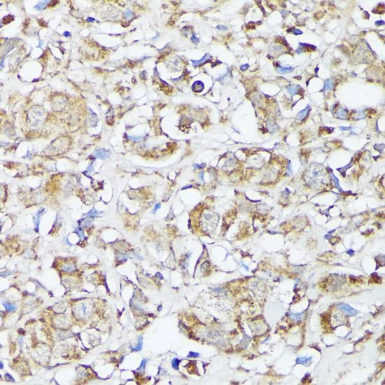 IHC-P analysis of human mammary cancer tissue using GTX64519 MTHFD2 antibody. Dilution : 1:100