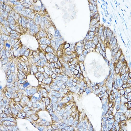 IHC-P analysis of human colon carcinoma tissue using GTX64544 TMPRSS2 antibody. Dilution : 1:50