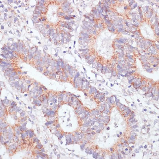 IHC-P analysis of human colon carcinoma tissue using GTX64554 RAP1A antibody. Dilution : 1:100