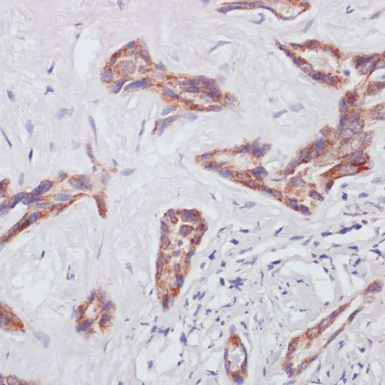 IHC-P analysis of human liver cancer tissue using GTX64554 RAP1A antibody. Dilution : 1:100