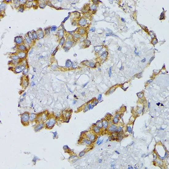 IHC-P analysis of human lung cancer tissue using GTX64557 ACADL antibody. Dilution : 1:100