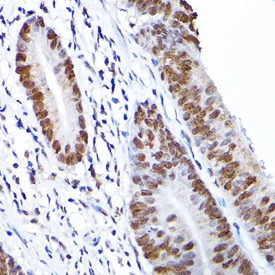 IHC-P analysis of human gastric cancer tissue using GTX64560 RCC1 antibody. Dilution : 1:100