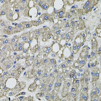 IHC-P analysis of human liver damage tissue using GTX64638 GFPT1 antibody. Dilution : 1:100