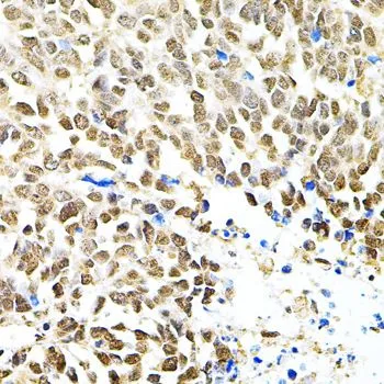IHC-P analysis of human lung cancer tissue using GTX64651 PNK antibody. Dilution : 1:100