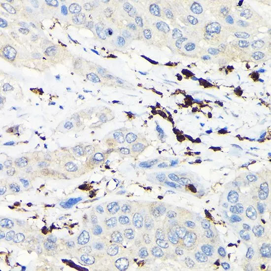 IHC-P analysis of human esophageal cancer tissue using GTX64657 Coronin 1A antibody. Dilution : 1:100