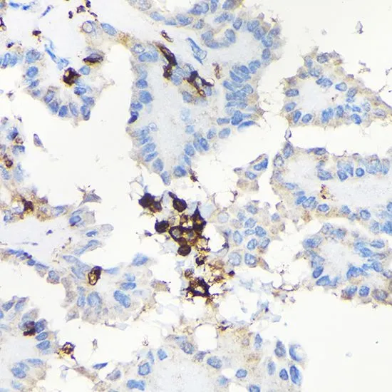 IHC-P analysis of human thyroid cancer tissue using GTX64657 Coronin 1A antibody. Dilution : 1:100