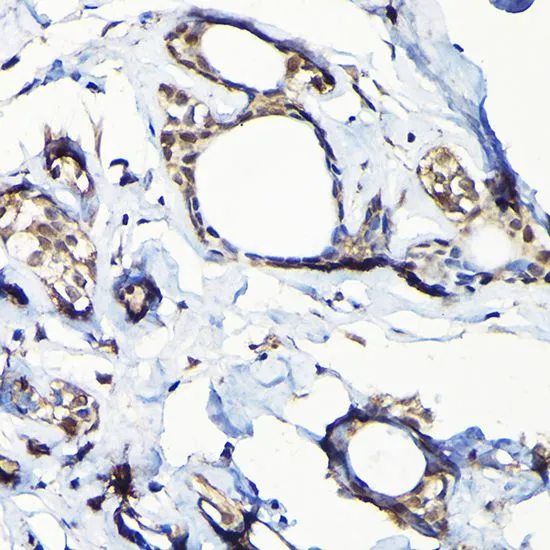 IHC-P analysis of human breast cancer tissue using GTX64671 USP5 antibody. Dilution : 1:100