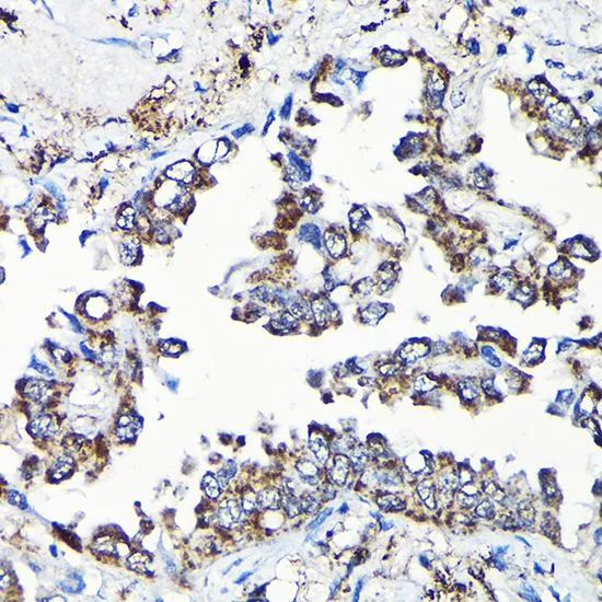 IHC-P analysis of human lung cancer tissue using GTX64671 USP5 antibody. Dilution : 1:100