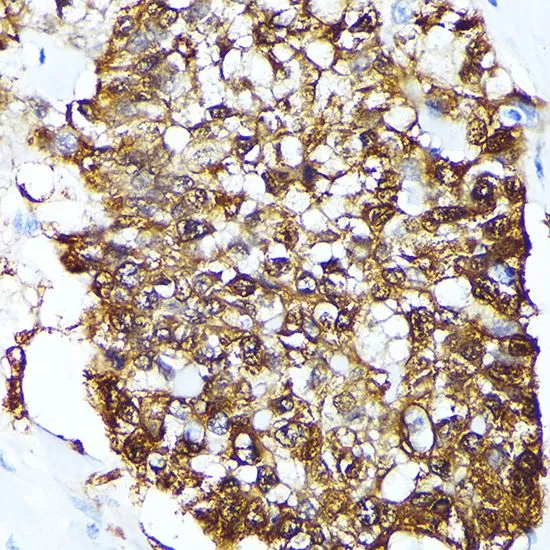 IHC-P analysis of human lung cancer tissue using GTX64678 FKBP4 antibody. Dilution : 1:100
