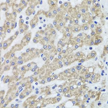 IHC-P analysis of human liver damage tissue using GTX64698 ACP1 antibody. Dilution : 1:100