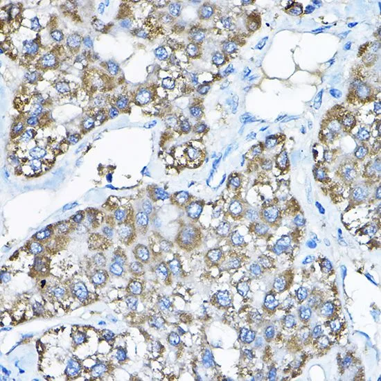 IHC-P analysis of human liver cancer tissue using GTX64701 NCE2 antibody. Dilution : 1:200