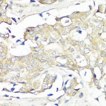 IHC-P analysis of human breast cancer tissue using GTX64714 eIF3B antibody. Dilution : 1:100
