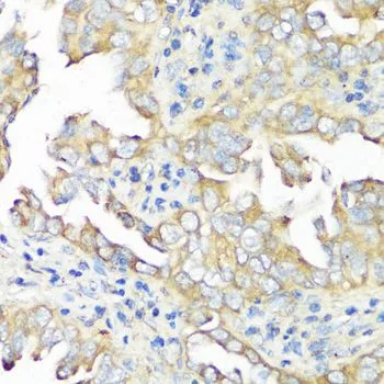 IHC-P analysis of human lung cancer tissue using GTX64714 eIF3B antibody. Dilution : 1:100
