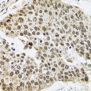 IHC-P analysis of human lung cancer tissue using GTX64747 SMARCD1 antibody.