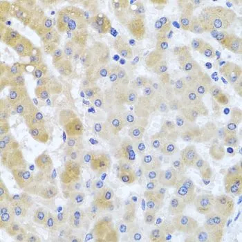 IHC-P analysis of human liver damage tissue using GTX64817 PCID1 antibody. Dilution : 1:100