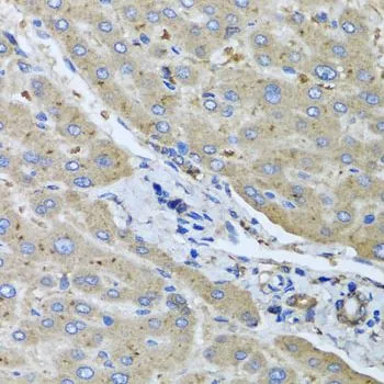 IHC-P analysis of human liver damage tissue using GTX64878 UGT2B10 antibody. Dilution : 1:100