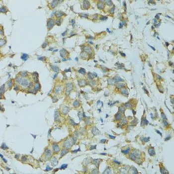 IHC-P analysis of human breast cancer tissue using GTX64899 CYP2B6 antibody. Dilution : 1:100