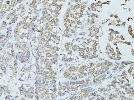 IHC-P analysis of human colon carcinoma tissue using GTX64957 TEFM antibody. Dilution : 1:100
