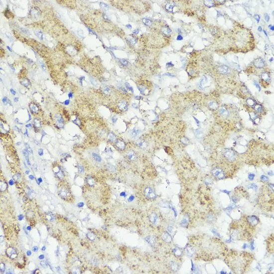 IHC-P analysis of human liver cancer tissue using GTX65551 SOCS6 antibody. Dilution : 1:100