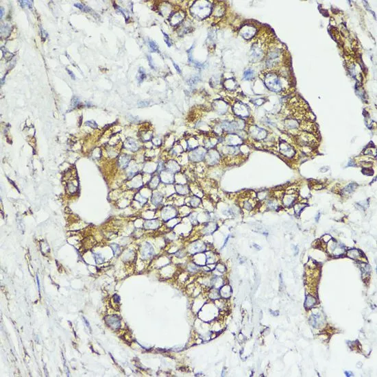 IHC-P analysis of human lung cancer tissue using GTX65551 SOCS6 antibody. Dilution : 1:100