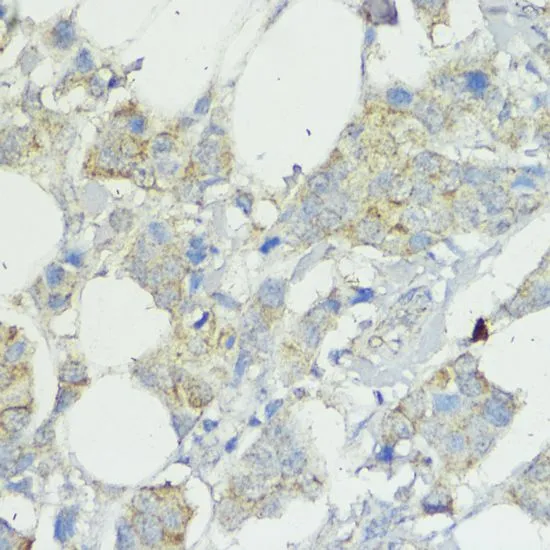 IHC-P analysis of human mammary cancer tissue using GTX65551 SOCS6 antibody. Dilution : 1:100