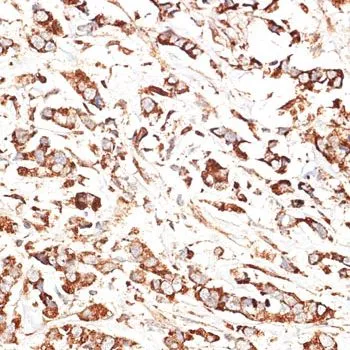 IHC-P analysis of human breast cancer tissue using GTX65557 KLHL9 antibody. Dilution : 1:100