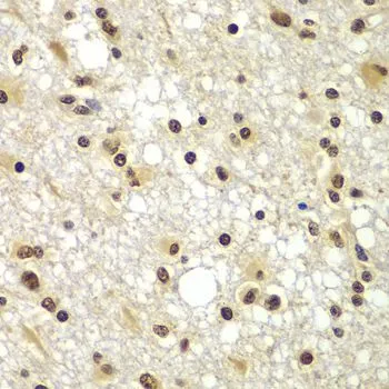 IHC-P analysis of human brain cancer tissue using GTX65596 ZNF20 antibody. Dilution : 1:100