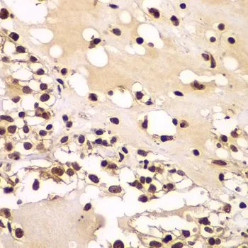 IHC-P analysis of human kidney cancer tissue using GTX65596 ZNF20 antibody. Dilution : 1:100