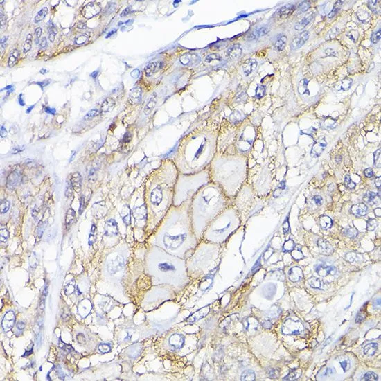 IHC-P analysis of human esophageal cancer tissue using GTX65618 SEMA4F antibody. Dilution : 1:200