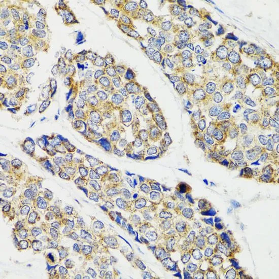 IHC-P analysis of human esophageal cancer tissue using GTX65841 IKK gamma antibody. Dilution : 1:100