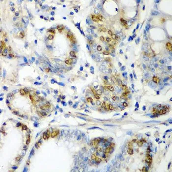IHC-P analysis of human colon carcinoma tissue using GTX65843 alpha A Crystallin antibody. Dilution : 1:200