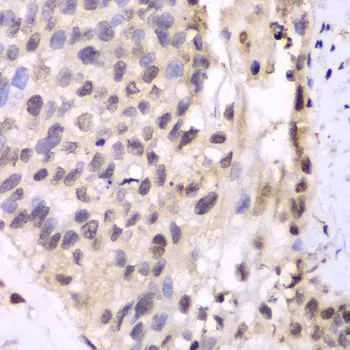 IHC-P analysis of human lung cancer tissue using GTX65847 PSMA6 antibody. Dilution : 1:100
