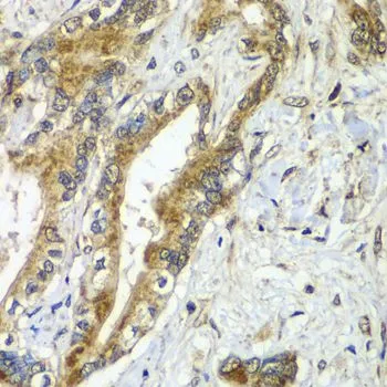 IHC-P analysis of human liver cancer tissue using GTX65871 Apc6 antibody. Dilution : 1:100