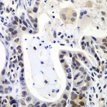 IHC-P analysis of human gastric cancer tissue using GTX65872 LSM2 antibody. Dilution : 1:100