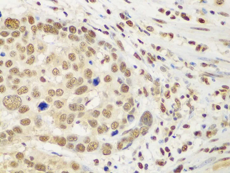IHC-P analysis of human esophageal cancer tissue using GTX65924 HDAC2 antibody. Dilution : 1:100