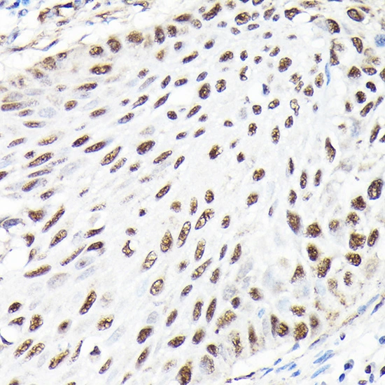 IHC-P analysis of human lung cancer tissue using GTX65926 CTCF antibody. Antigen retrieval : 0.01M Citrate Buffer, pH 6.0 Dilution : 1:100