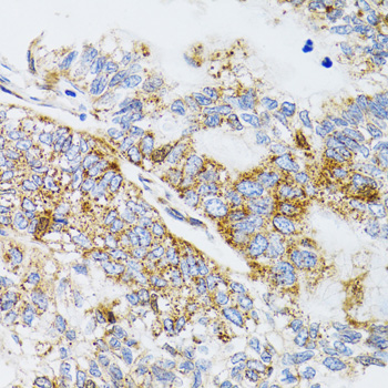 IHC-P analysis of human lung cancer tissue using GTX65945 ProDynorphin antibody. Dilution : 1:100